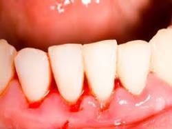 How to treat sore gums