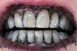 Як відбілити зуби активованим вугіллям