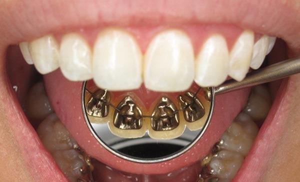 Features of lingual braces