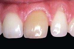 Отбеливание зубов после травмы