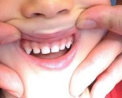 Фторирование зубов у детей для чего