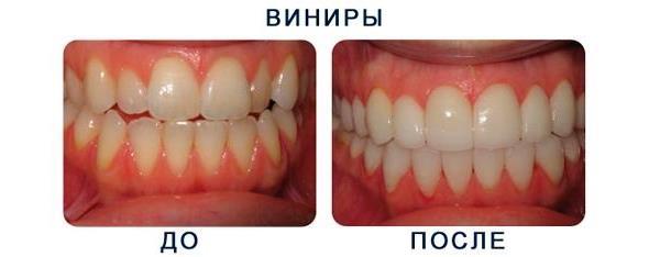 До и после непрямой реставрации зубов