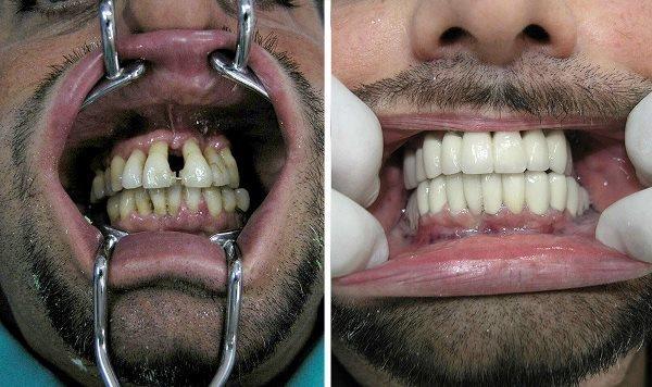 Востребованность имплантации зубов 