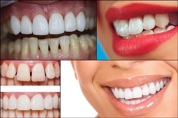 aesthetic restoration of teeth