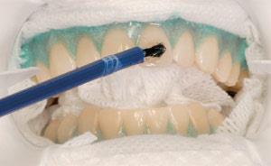 Может ли отбеливание повредить зубы?