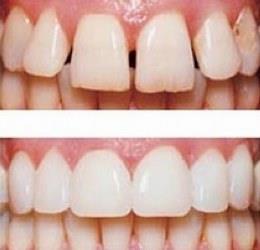 Художественная реставрация зубов: до и после