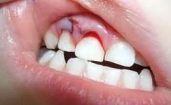 Ушиб зуба