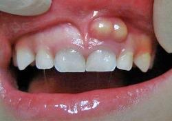 Абсцесс вследствие больного зуба