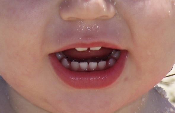 Как снять зубную боль у ребенка?
