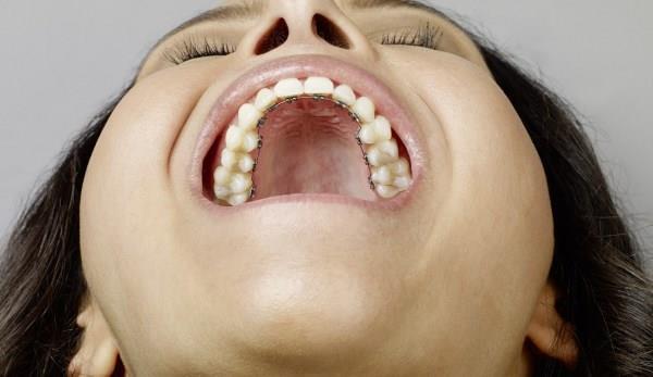 Benefits of lingual braces