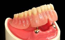 Использование имплантатов при отсутствии большого количества зубов