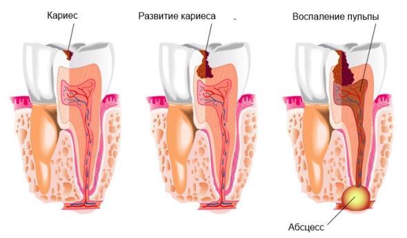 Абсцесс вследствие больного зуба