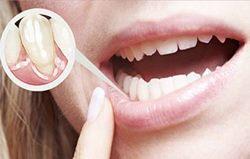 Подвижность зубов: степени, причины и лечение