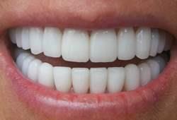 Aesthetic restoration of teeth