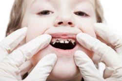 У ребенка болит зуб: кариес