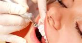 Removal of dental deposits, their types and causes of formation