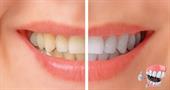 Способы отбеливания зубов в домашних условиях. Самые эффективные и безопасные процедуры