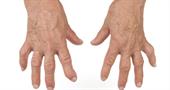 Is there a link between oral health and rheumatoid arthritis?