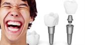Зубные имплантаты: что это и кому они подходят?