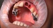 Причины, симптомы и лечение альвеолита после удаления зуба