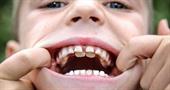 Прорізування корінних молочних зубів у дітей. Графік та симптоми 