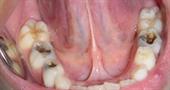 Лікування пульпіту молочних зубів у дітей