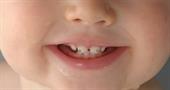 Почему у ребенка налет на зубах? Все о причинах и лечении