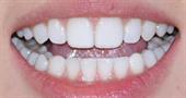 Реставрация зубов композитными винирами