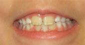 Пожовтіння зубів у дітей: причини та способи повернути білизну