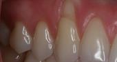 Оголение зубов. Причины и лечение народными средствами