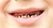 Caries can interfere with the growth of children