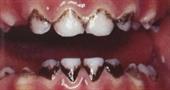 Почему у детей и взрослых чернеют зубы и что с этим делать?