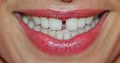 Можно ли убрать щель между передними зубами и как она появляется?