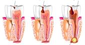Абсцесс зуба и десны: симптомы, причины, лечение и профилактика
