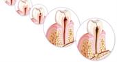 Заболевания пульпы зуба. Причины, лечение, профилактика и диагностика