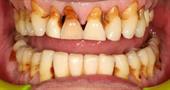 Что делать, если от пародонтоза начали выпадать зубы?