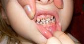 Чому чорніють зуби у дитини?