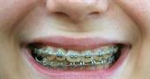 High fluoride toothpaste is good for anyone with braces