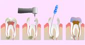 Как происходит лечение каналов зубов