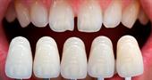 The main indications for the installation of veneers
