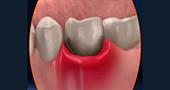 Causes of pain in the gums and ways to treat them at home