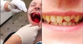 Травмы зубов и их лечение