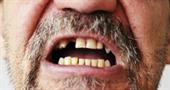 Гнилые зубы: последствия для организма и лечение