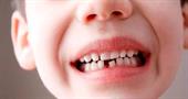 Молочні зуби випали, а корінні не зростають. У чому причина та що робити? 