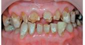 Что такое некроз твердых тканей зубов?