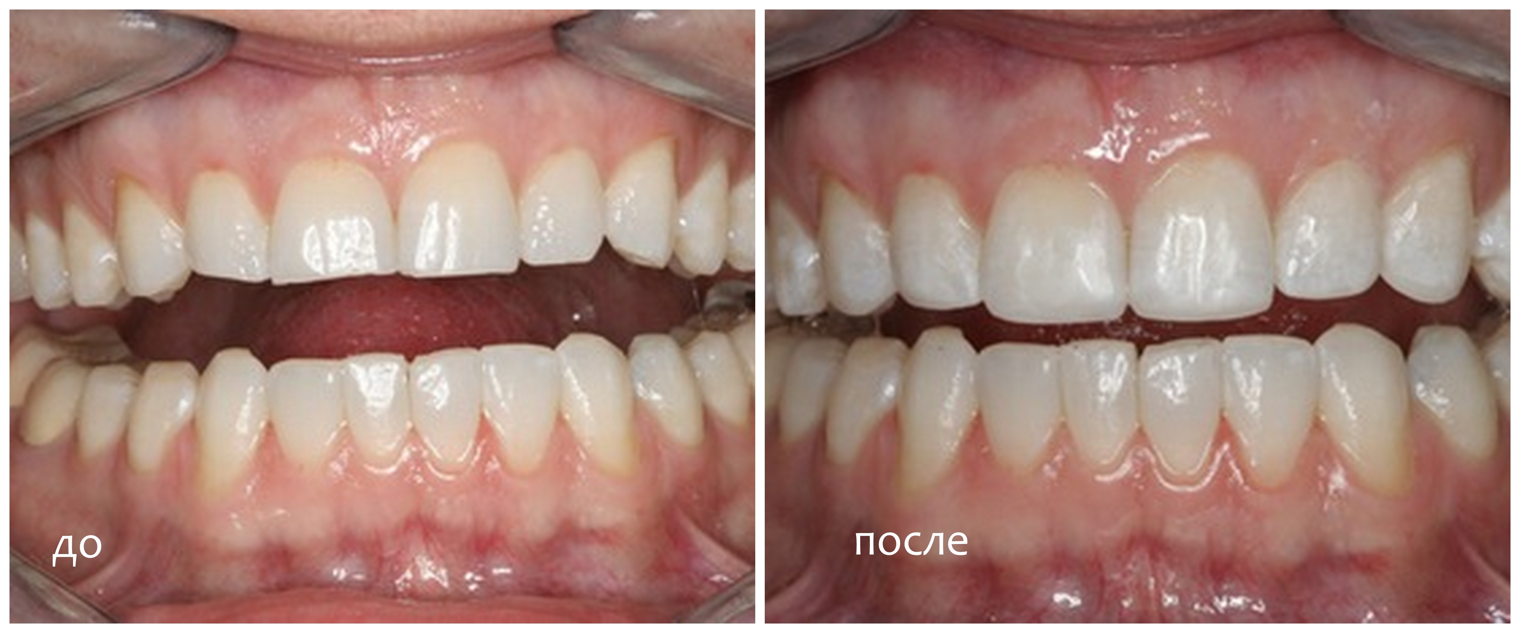Реставрация зубов винирами: фото до и после