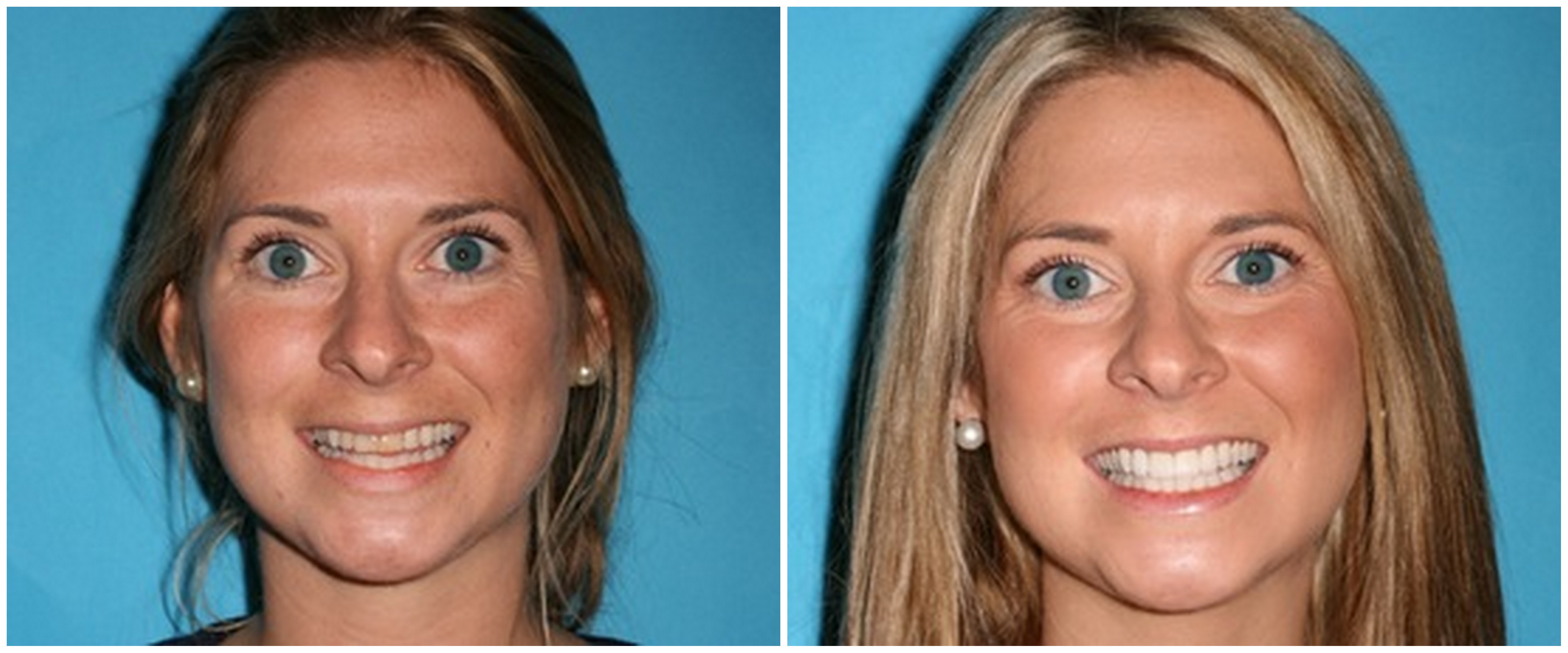 Реставрация зубов винирами: фото до и после