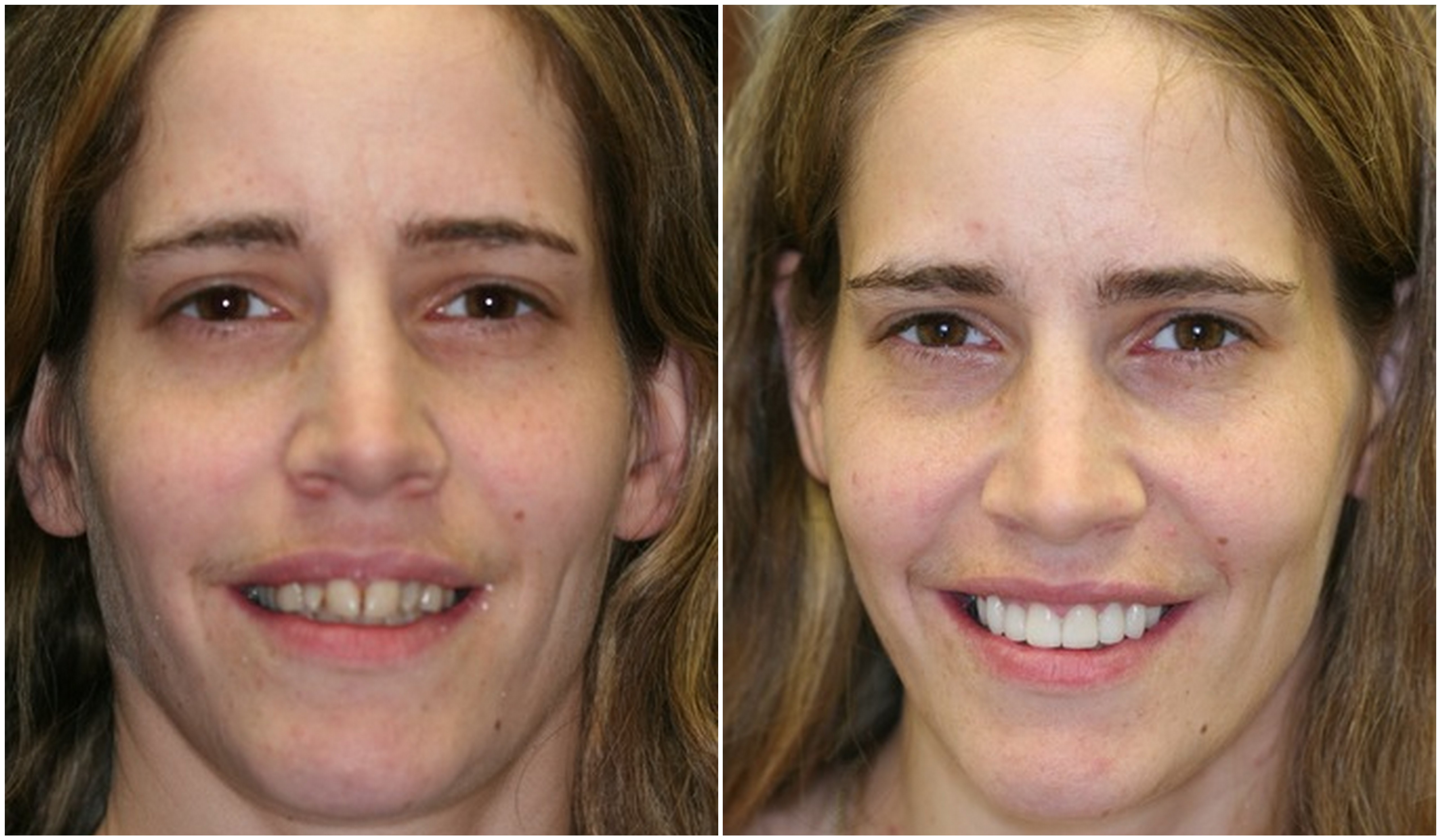 Виниры на кривые зубы до и после