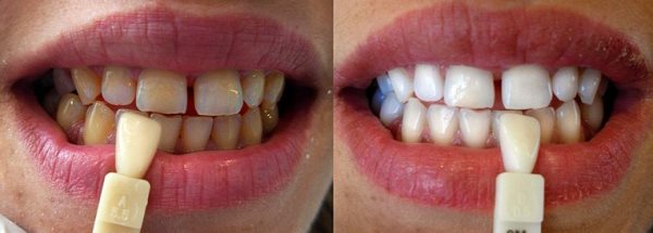 Лазерное отбеливание зубов: фото до и после