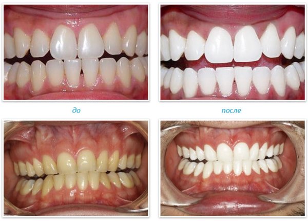 Лазерное отбеливание зубов: фото до и после